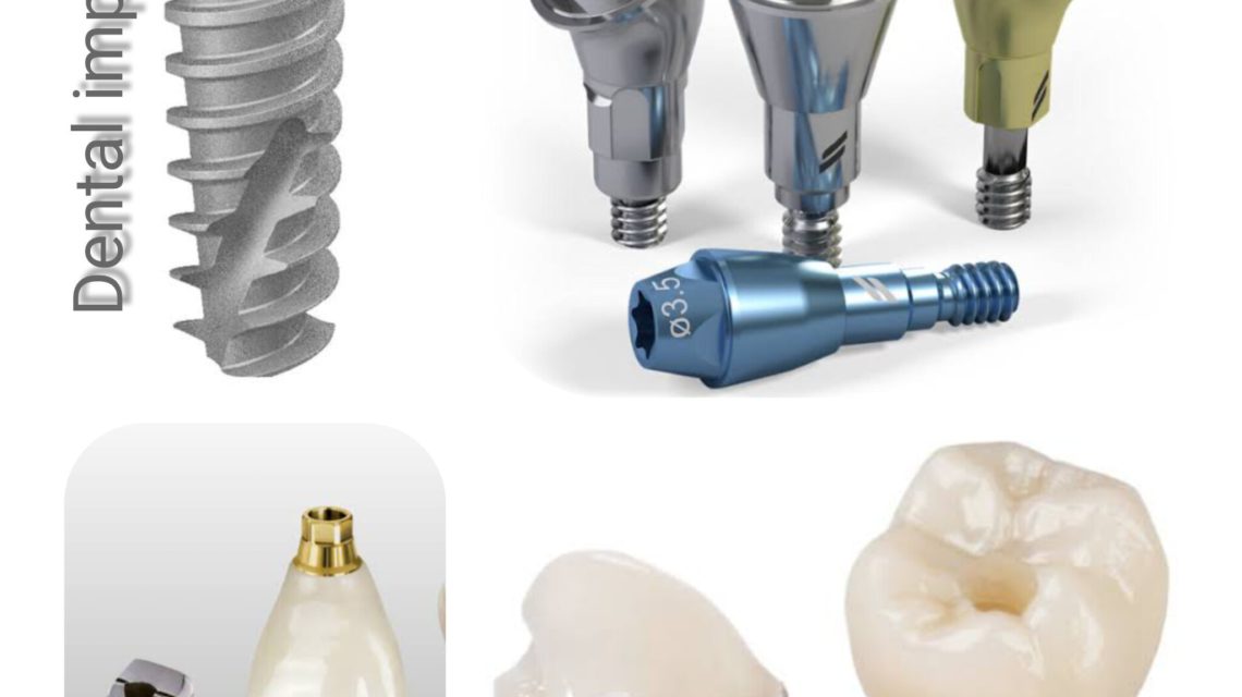 Looking For Dental Implants Near Me