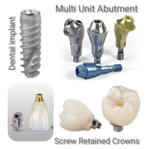 Looking For Dental Implants Near Me